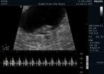 7th week Ultrasound
