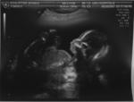 21th week ultrasound